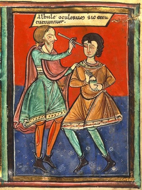 Opération de la cataracte. Enluminure anglaise de 1190