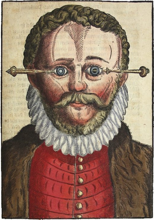 Instrument utilisé lors de l'opération de la cataracte. Gravure extraite de Ophthalmodulea. Das ist Augendienst de Georg Bartisch, paru en 1583